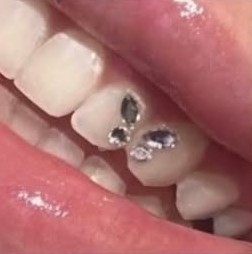 Strass dentaires posés sur les incisives